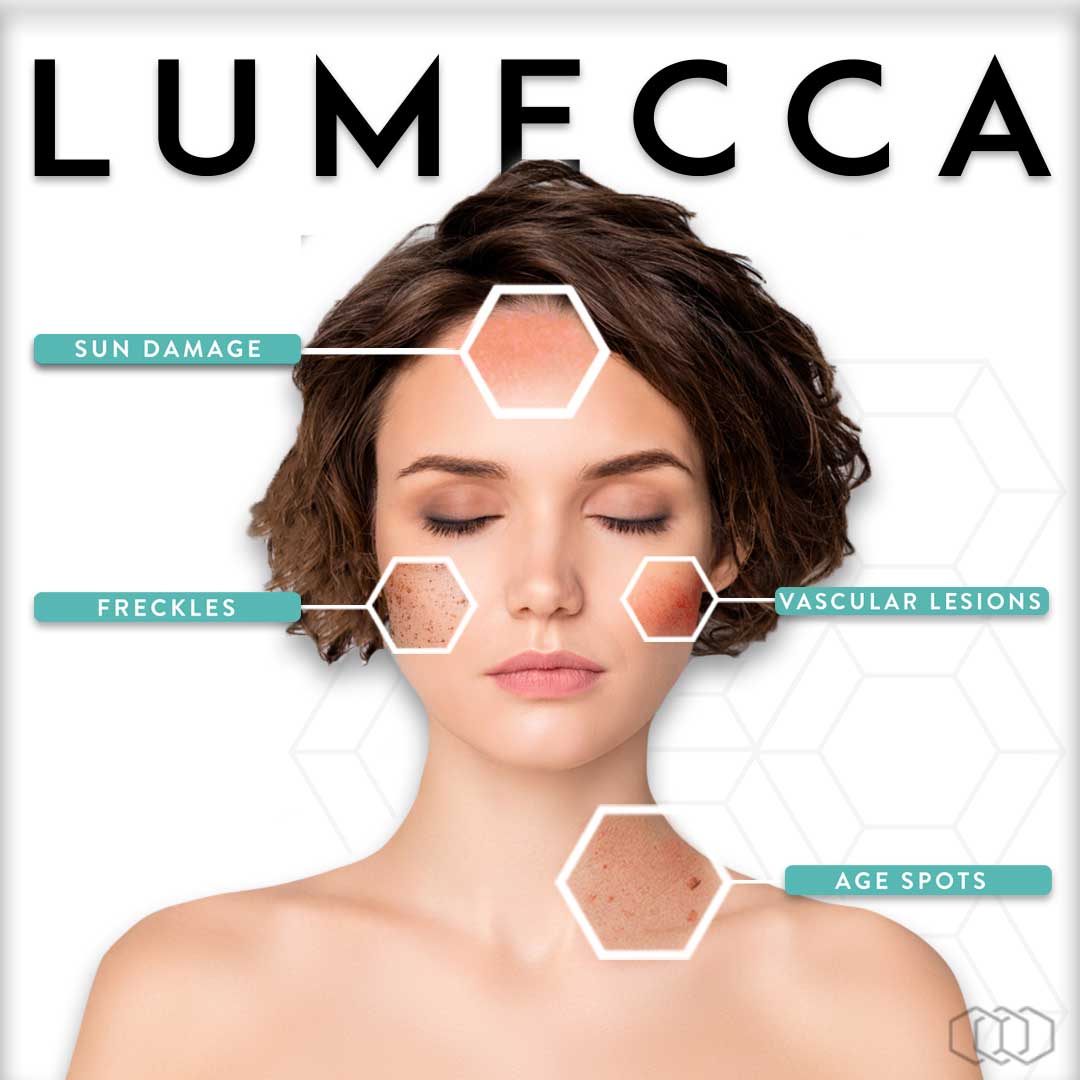 1 Year Lumecca IPL Membership